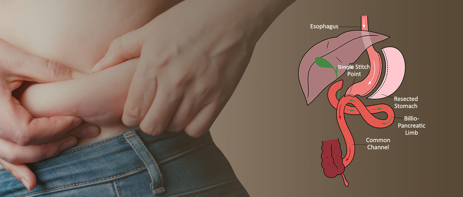 duodenal bariatric surgery in indore, bariatric surgery in indore, weight loss doctor in indore, weight loss indore