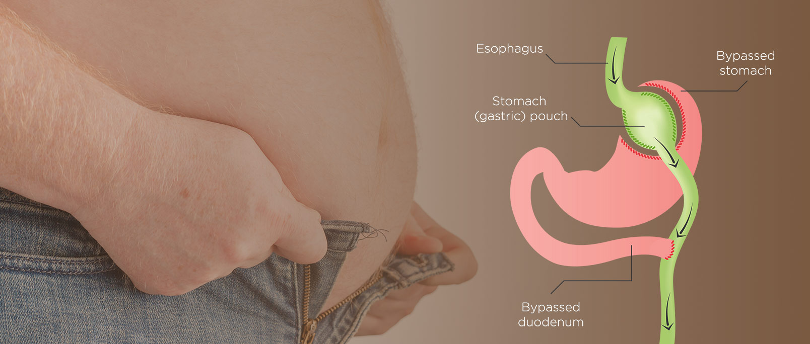 gastric bypass bariatric surgery in indore, gastric bypass in indore, gastric bypass surgery in indore