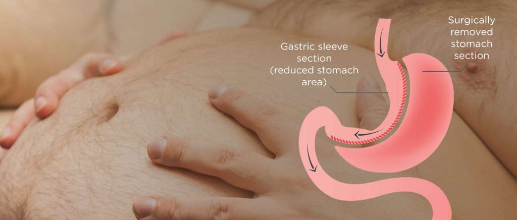 gastric sleeve bariatric surgery in indore, gastric sleeve operation in indore, gastric sleeve surgery in indore